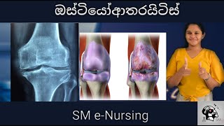 Osteoarthritis Clinical Presentation Sinhala [upl. by Sillad]