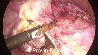 Total laparoscopic hysterectomy TLH [upl. by Puiia]