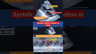 Systolic Anterior motion SAM of mitral valve in HCM l Hypertrophic cardiomyopathy hcm shorts [upl. by Haelam507]