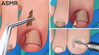 ASMR Ingrown toenail removal treatment foot care animation  Satisfying tingle [upl. by Aihsekan514]