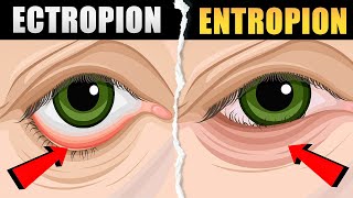 Ectropion and Entropion  Causes Symptoms Types and Treatment  Ectropion vs Entropion [upl. by Adneram]