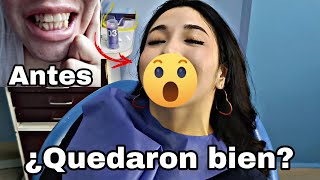 Me quitan los brackets después de 3 años en tratamiento  el resultado es increíble [upl. by Abramson]