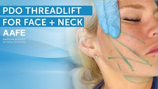 NonSurgical Face and Neck Lift with PDO Lifting Threads  AAFE [upl. by Origra259]