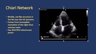 Normal Right Atrial Variants [upl. by Born]