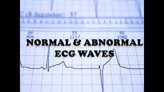 ECG INTERPRETATION  NORMAL WAVES AND ABNORMAL WAVES IN TAMIL  ABNORMAL ECG WAVE INDICATION [upl. by Keele]