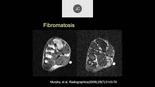 MRI of Soft Tissue Tumors  Part 2 [upl. by Ajssatan]