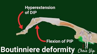 Pathophysiology of Boutonniere Deformity animated [upl. by Ardnayek]