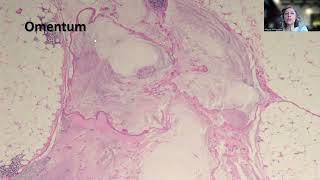 Tip85Lowgrade Appendiceal Mucinous Neoplasm LAMN [upl. by Euginimod413]