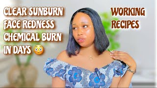 HOW TO PREVENT amp CLEAR SUNBURN FACE REDNESS amp CHEMICAL BURN Joy Ababah [upl. by Gibbons]