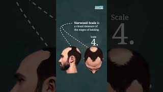 Check Your Hair Loss Pattern  DHI India [upl. by Aleahcim913]