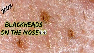 BlackheadsWhiteheads RemovalNoseClose up Extraction [upl. by Yzdnil]