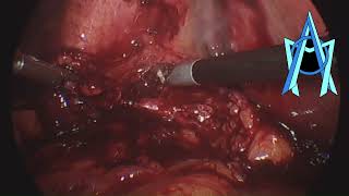 Acute cholecystitis Acute appendicitis  Colecistitis aguda Apendicitis aguda [upl. by Izy]