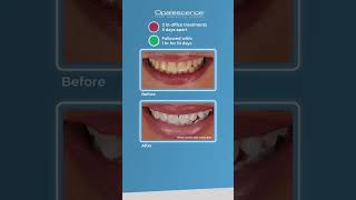 Opalescence™ Boost™ and Opalescence Go™  Case Study [upl. by Eckardt]