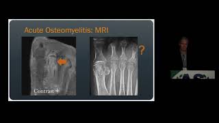 Imaging of Osteomyelitis amp Septic Arthritis  15 Minute Radiology CME [upl. by Candy]