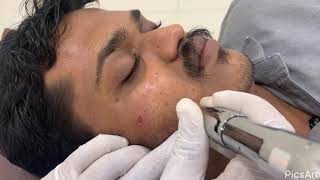 Microneedling Treatment For Chicken Pox Scar Marks On Skin by Dr Vaseem Choudhary [upl. by Rodgiva]