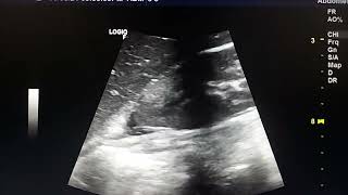 pyelonephritis ultrasound findings [upl. by Atinev777]