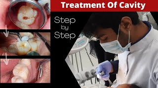 Composite Filling Step by Step  Cavity In Tooth  How To Fill Decayed Tooth  Dr Sunil Kumar [upl. by Euqnomod778]