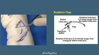 8 3 Rotation Flap Skin Flaps Essential Surgical Skills WhiteKnightLove [upl. by Aimej]