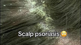 Scalp Psoriasis Removal [upl. by Atsira]