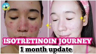 PANO NAWALA PIMPLES KO  EFFECTIVE 1 Month Update [upl. by Airotel]