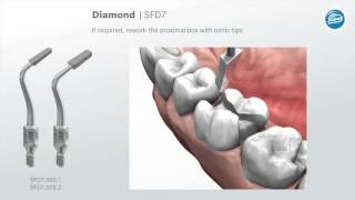 Preparation rules for ceramic inlays and partial crowns [upl. by Jueta]