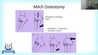 Complications of Lateral condyle Fractures and their Management by Dr Kapil Gangwal [upl. by Aicak]