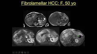 International Cancer Imaging Society Course Oct 17 Rare and unusual liver tumours G Morana [upl. by Nanek319]