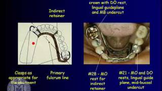 DENT 718 Removable partial dentures design considerations [upl. by Tneicniv500]