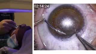 London Vision Clinic  ReLEx SMILE  Live laser eye surgery  Professor Dan Reinstein [upl. by Norag]