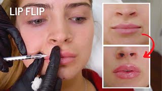 Before amp After Natural Botox Lip Flip ft Carrington Durham [upl. by Koenraad]