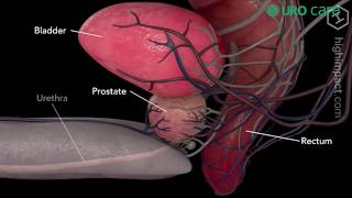 Câncer de Próstata  Incontinência Urinária  Tipos de Tratamento  Cirurgia [upl. by Sass]