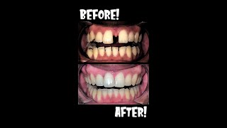 25 Years of BRACES in 40 seconds BEFORE AND AFTER Closing Large Teeth Gap🦷Shorts braces [upl. by Armanda665]