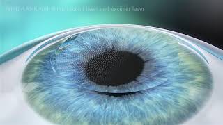 What is LASIK [upl. by Esile]