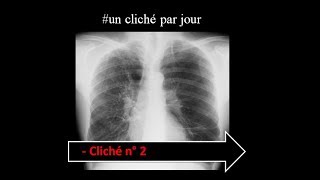 unclichéthoraciqueparjour  interprétation radiologique type emphysème pulmonaire diffus [upl. by Eek]