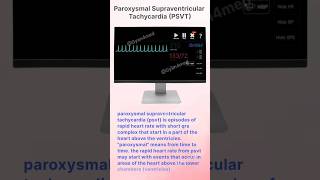 Paroxysmal Supraventricular Tachycardia PSVT [upl. by Otokam]