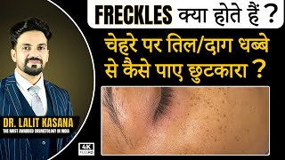 Freckles क्या होता हैं  चेहरे पर तिल दाग धब्बे से कैसे पाए छुटकारा  at Dr Kasana Clinic [upl. by Kcirneh]