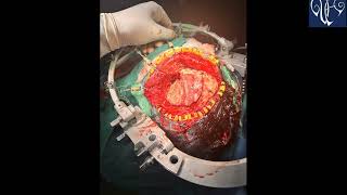 PLANUM SPHENOIDALE MENINGIOMA EXCISION  DR VIJAYMAHANTESH PUJARI [upl. by Cyprian769]