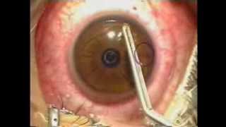 Lasik Laser Eye Surgery Procedure  Live Surgery [upl. by Abibah]