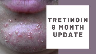 TRETINOIN CREAM 9 MONTH UPDATE  Whiteheads purging and giving up tretinoin tretinoinpurge [upl. by Yecaj107]