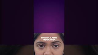 Demystifying Orbicularis Myokymia in 60 seconds Understand causes and discover treatment options [upl. by Victory]