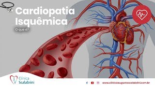 Cardiopatia Isquêmica  Por Prof Augusto Scalabrini Neto [upl. by Teriann]