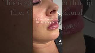 Temecula California Best Lip Filler💋 [upl. by Tench]