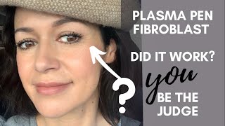 Fibroblast Plasma Pen  Does It Work YOU decide My 3 Month Before amp After Pics amp Videos [upl. by Engelbert]