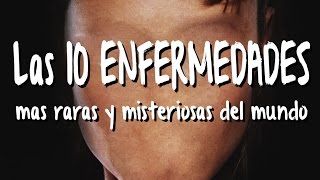 Las 10 ENFERMEDADES MAS MISTERIOSAS y raras del mundo [upl. by Zawde]