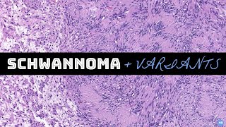 Schwannoma amp Variants  Spindle Cell Unknowns Case 1  BSTPATH Cases for Residents [upl. by Lita535]