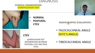 Congenital Talipes Equino Varus CTEV  Rapid Revision of Orthopaedics by Dr Prateek Joshi [upl. by Leora]