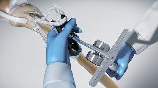 INTRAFIX™ ADVANCE Tibial Fastener System [upl. by Atnim]