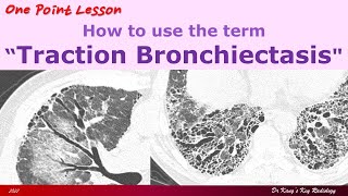 Traction Bronchiectasis [upl. by Ekrub]