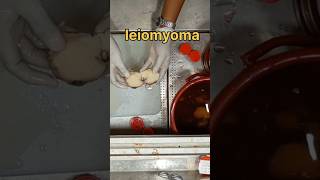 Leiomyoma smooth muscle tumour specimen லியோமியோமா [upl. by Weatherby]