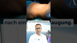 fettabsaugung fettabbau fettabnehmen plastischechirurgie düsseldorf [upl. by Nibuz292]